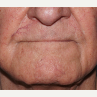 65-74 year old man treated with Vein Treatment before 2831054