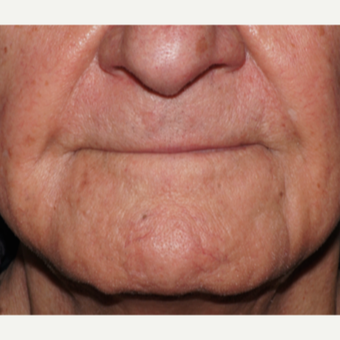 65-74 year old man treated with Vein Treatment after 2831054