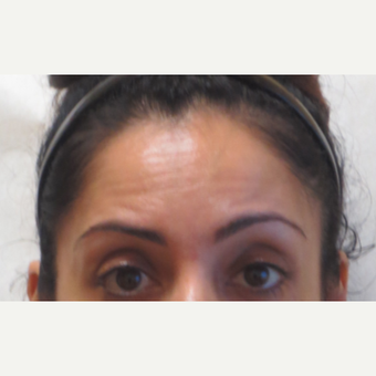 35-44 year old woman treated with Botox before 3381402
