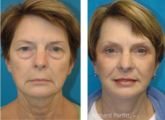 Upper and Lower Blepharoplasty with a Facelift rejuvenate this 50+ Female before 1091518