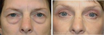 Upper and Lower Blepharoplasty with a Facelift rejuvenate this 50+ Female after 1091518