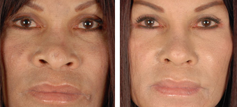 Revision Rhinoplasty before 1208278