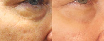 ePrime and CO2RE treatment on 64 year old Female before 1082826