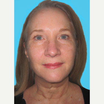 Facelift before 3826854