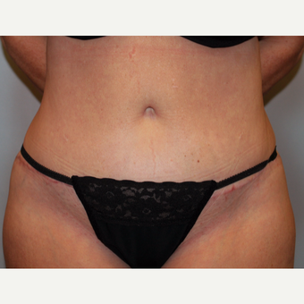 35-44 year old woman treated with Tummy Tuck after 3803267
