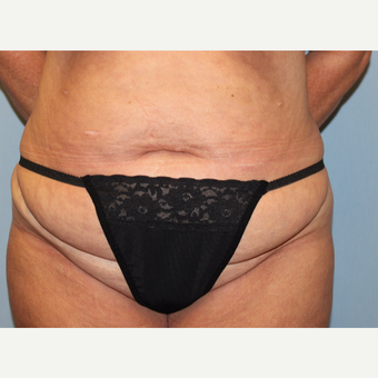 35-44 year old woman treated with Tummy Tuck before 3803267