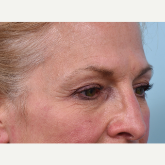 55 year old woman treated with Liquid Facelift before 3610800