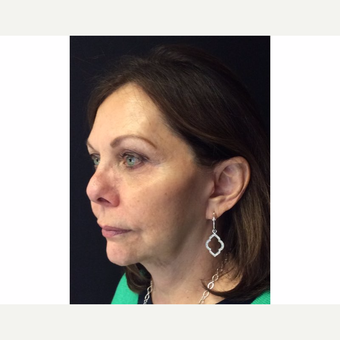 67 year old woman treated with Vertical Vector Lower Face Lift under Tumescent Anesthesia after 3701710