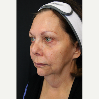 67 year old woman treated with Vertical Vector Lower Face Lift under Tumescent Anesthesia before 3701710