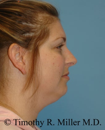 Lower facial rejuvenation before 1447441