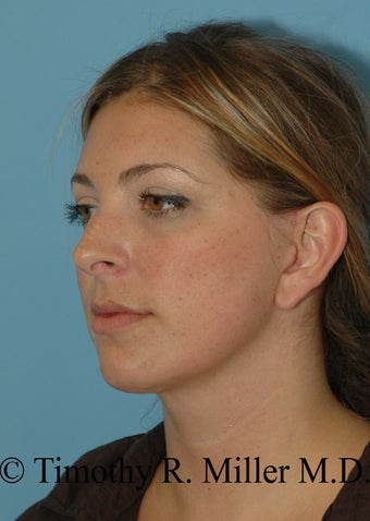 Lower facial rejuvenation 1447441