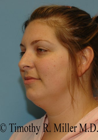 Lower facial rejuvenation 1447441