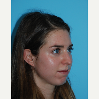 24 year old woman after rhinoplasty one month ago before 3140076
