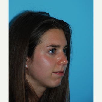 24 year old woman after rhinoplasty one month ago after 3140076