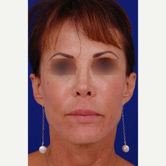 35-44 year old woman treated with Revision Rhinoplasty 1850625