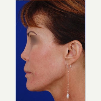 35-44 year old woman treated with Revision Rhinoplasty before 1850625