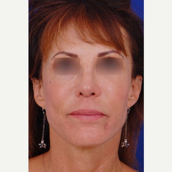 35-44 year old woman treated with Revision Rhinoplasty 1850625
