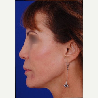 35-44 year old woman treated with Revision Rhinoplasty after 1850625