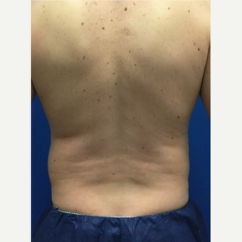 Male patient treated with Laser Liposuction before 3071895