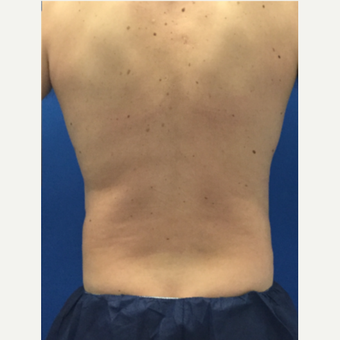 Male patient treated with Laser Liposuction after 3071895