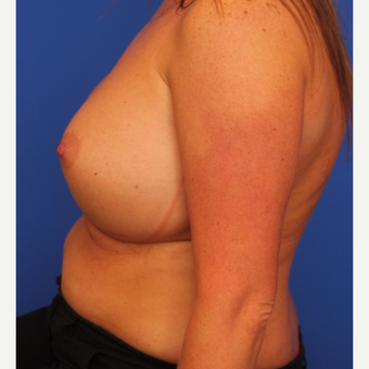32- year old woman treated with Breast Augmentation after 3108713