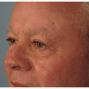 65-74 year old man treated with Eyelid Surgery after 3074760