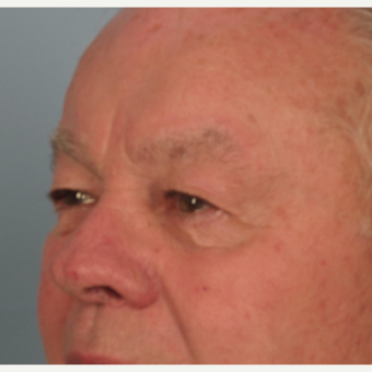 65-74 year old man treated with Eyelid Surgery before 3074760