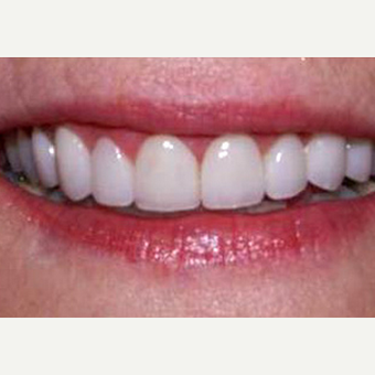 Porcelain Veneers with Gum Lift after 1784505
