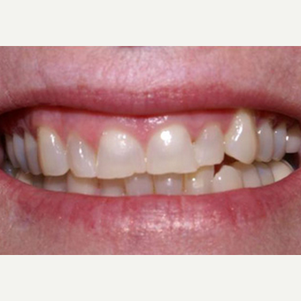 Porcelain Veneers with Gum Lift before 1784505