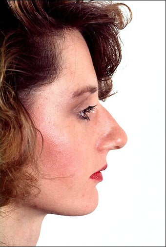 Rhinoplasty before 1023289