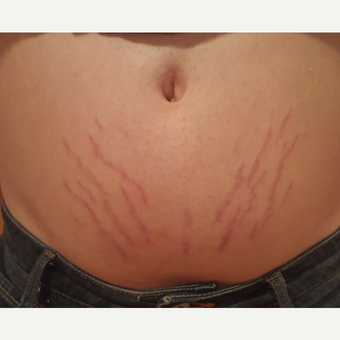 18-24 year old man treated with Stretch Marks Device before 3199725