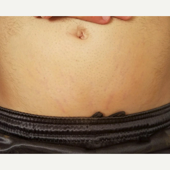 18-24 year old man treated with Stretch Marks Device after 3199725