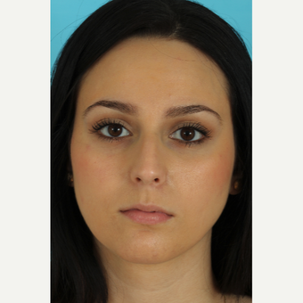 25-34 year old woman treated with Rhinoplasty before 3618303