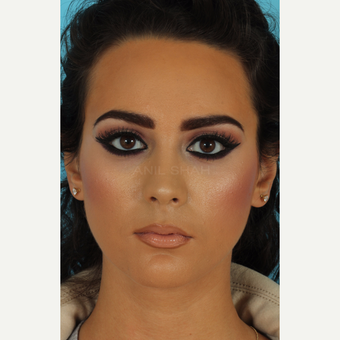 25-34 year old woman treated with Rhinoplasty after 3618303