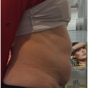 55-64 year old woman treated with Non-Surgical Body Contouring Treatment before 3724458