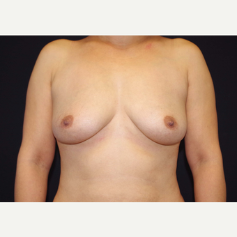 35-44 year old woman treated with Breast Implants before 3441099