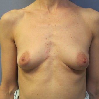 45-54 year old woman treated with Breast Augmentation before 1685068