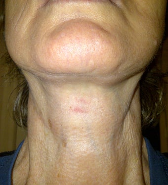 Lower Face Lift allows for great improvement for the neck as well after 1040221