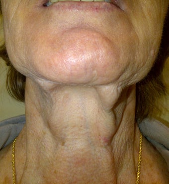 Lower Face Lift allows for great improvement for the neck as well before 1040221