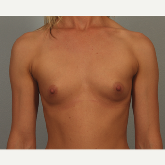 25-34 year old woman with mammary hypoplasia; fit with very little body fat before 3418698