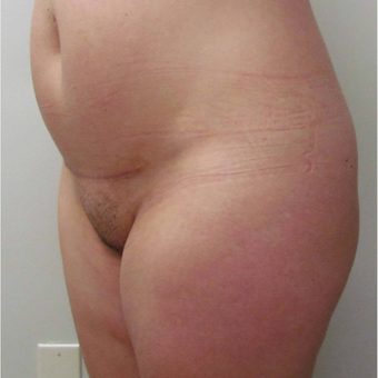 Monsplasty for this 33 Year Old Woman after 3001018