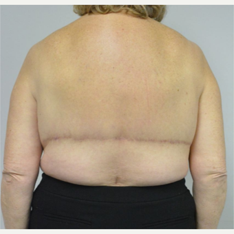 65-74 year old woman treated with Upper Body Lift/ Bra Line Back Lift after 3850409