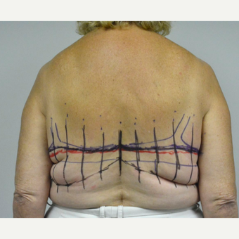 65-74 year old woman treated with Upper Body Lift/ Bra Line Back Lift before 3850409