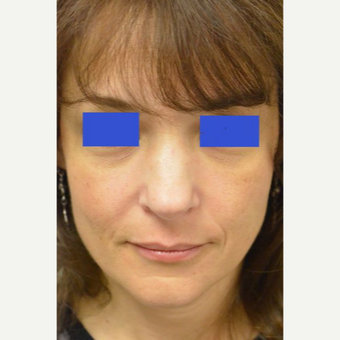 45-54 year old woman treated with a wide nose treated with a Rhinoplasty before 3482835