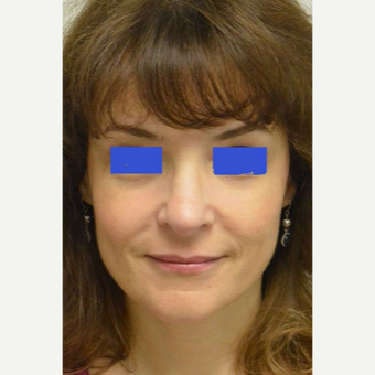 45-54 year old woman treated with a wide nose treated with a Rhinoplasty after 3482835