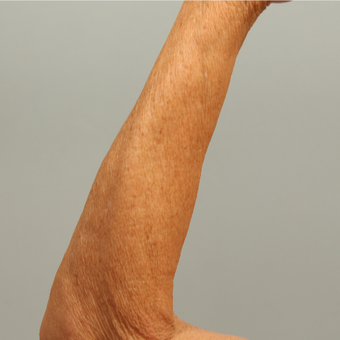 62 year old, sun damaged skin treated with microneedling and DefenAge postcare protocol, 1 tx after 3288905