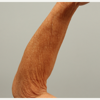 62 year old, sun damaged skin treated with microneedling and DefenAge postcare protocol, 1 tx before 3288905