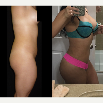18-24 year old woman treated with Brazilian Butt Lift before 3680314