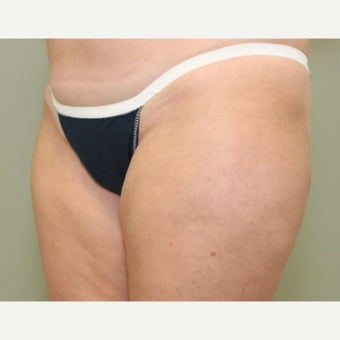 45-54 year old woman treated with CoolSculpting after 2090782