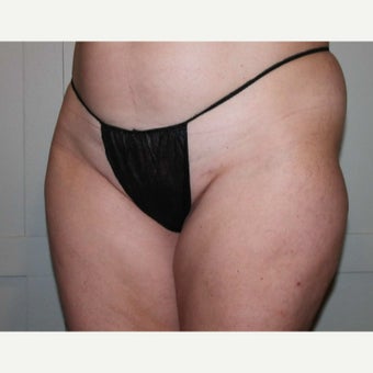 45-54 year old woman treated with CoolSculpting before 2090782